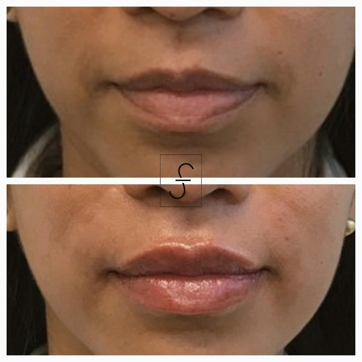 Lip Filler Before & After Gallery - Patient 944108 - Image 1