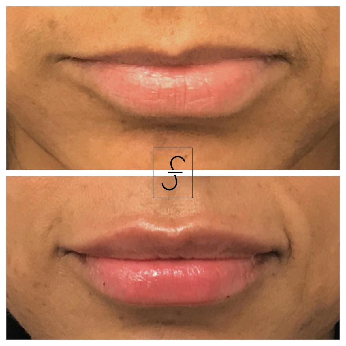 Lip Filler Before & After Gallery - Patient 306999 - Image 1