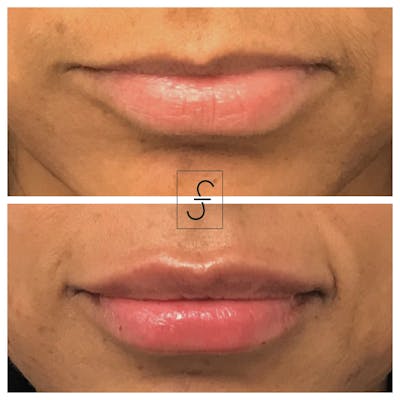 Lip Filler Before & After Gallery - Patient 306999 - Image 1