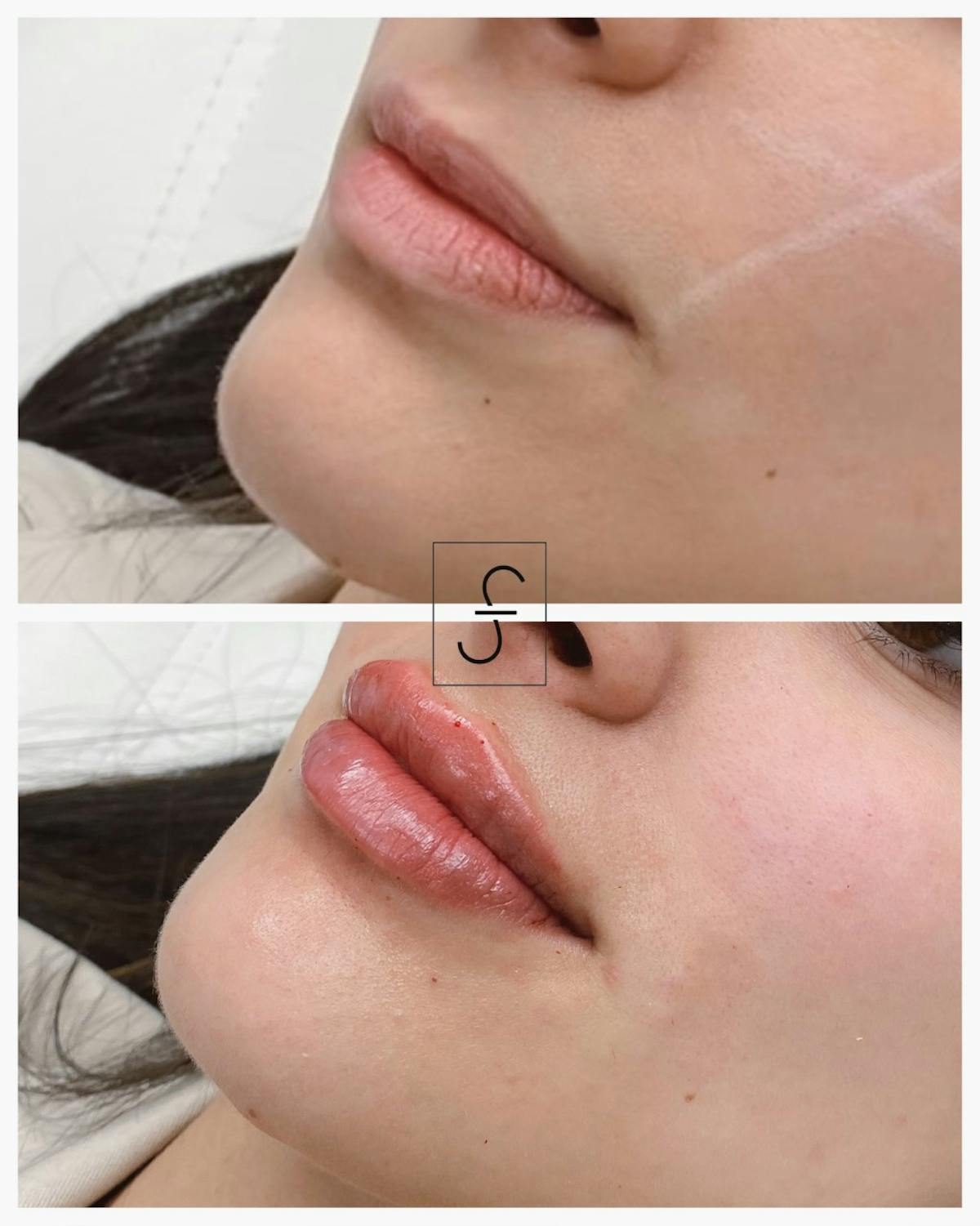 Lip Filler Before & After Gallery - Patient 258665 - Image 1