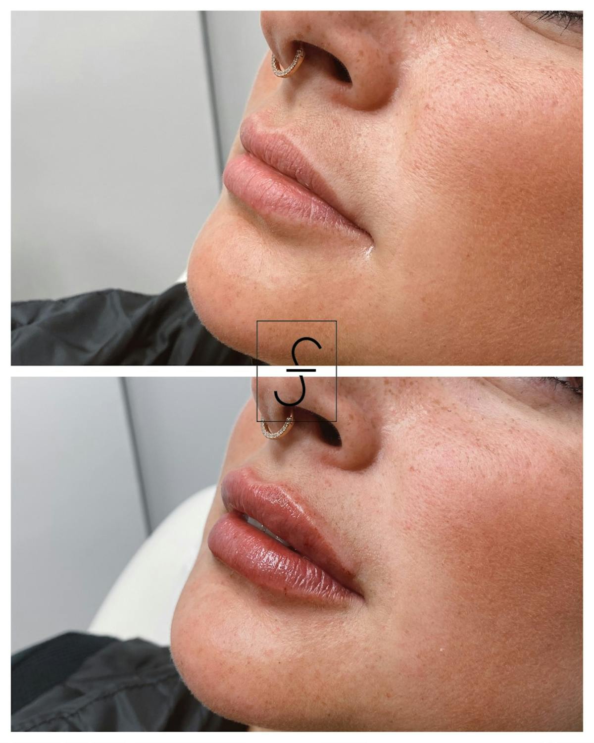Lip Filler Before & After Gallery - Patient 157221 - Image 1