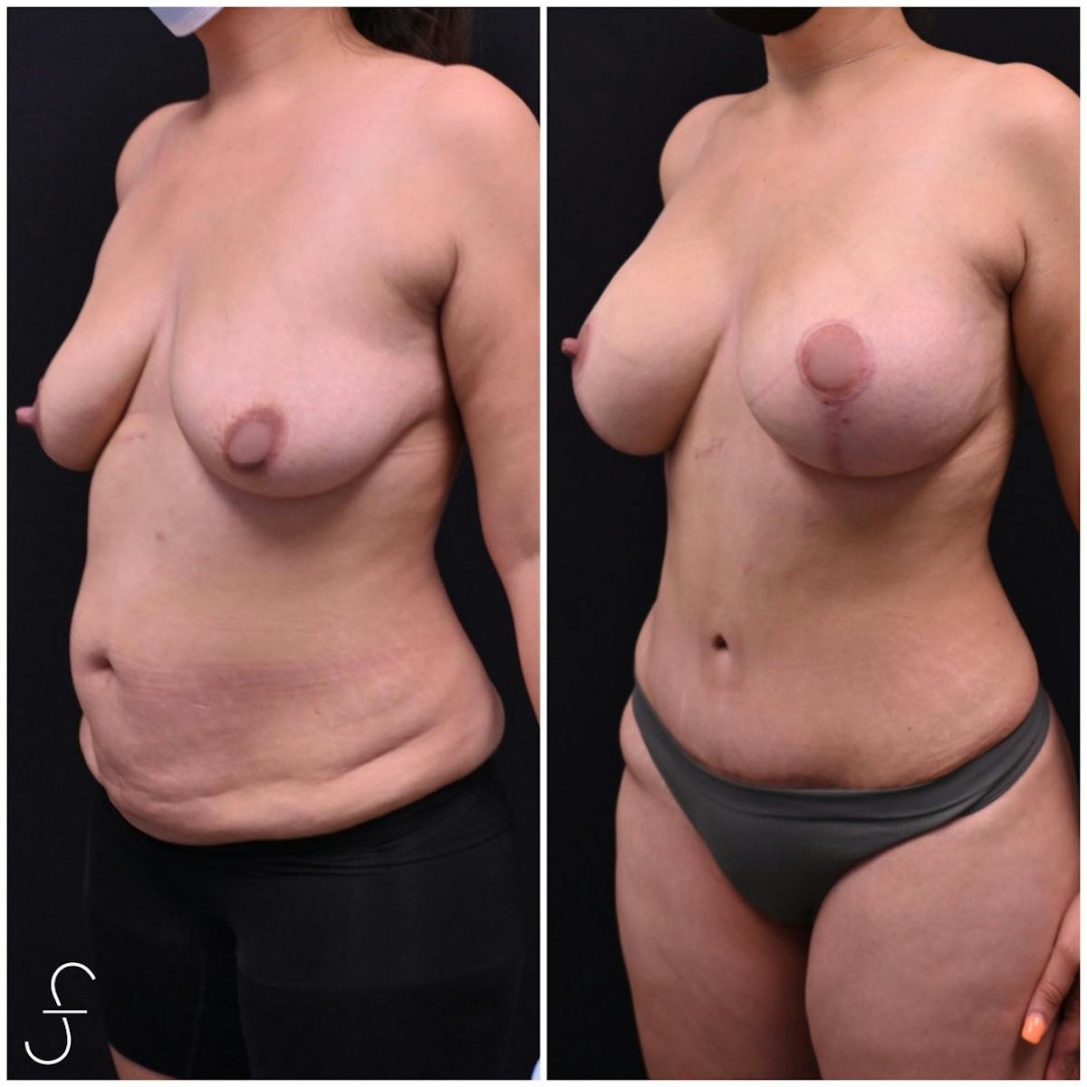 Abdominoplasty (Tummy Tuck) Before & After Gallery - Patient 305425 - Image 2