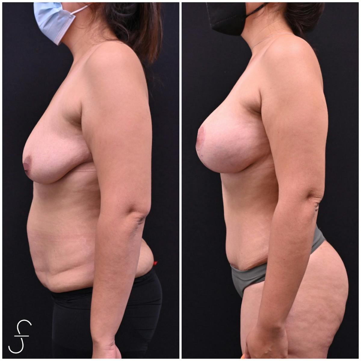 Abdominoplasty (Tummy Tuck) Before & After Gallery - Patient 305425 - Image 3