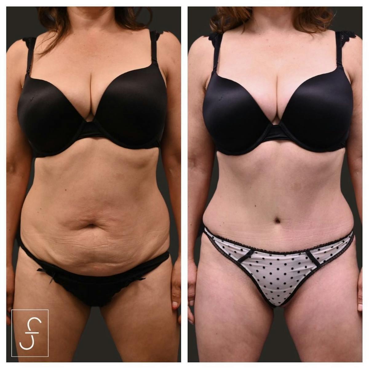 Abdominoplasty (Tummy Tuck) Before & After Gallery - Patient 352158 - Image 1