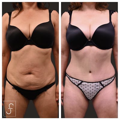Abdominoplasty (Tummy Tuck) Before & After Gallery - Patient 352158 - Image 1