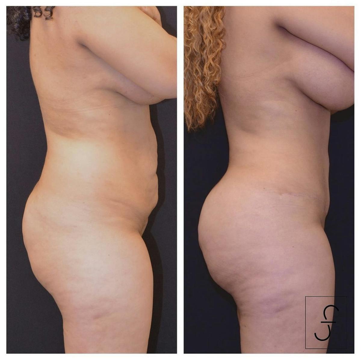Abdominoplasty (Tummy Tuck) Before & After Gallery - Patient 194181 - Image 1