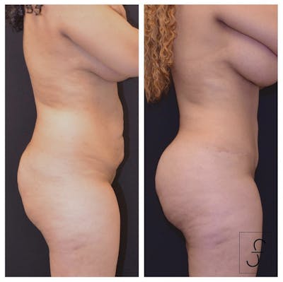 Abdominoplasty (Tummy Tuck) Before & After Gallery - Patient 194181 - Image 1