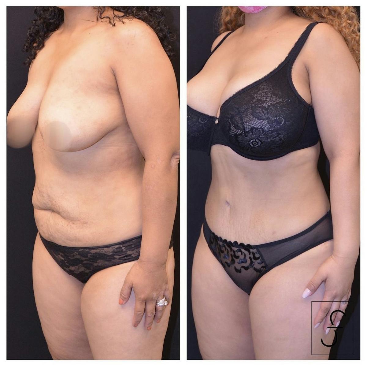 Abdominoplasty (Tummy Tuck) Before & After Gallery - Patient 194181 - Image 2