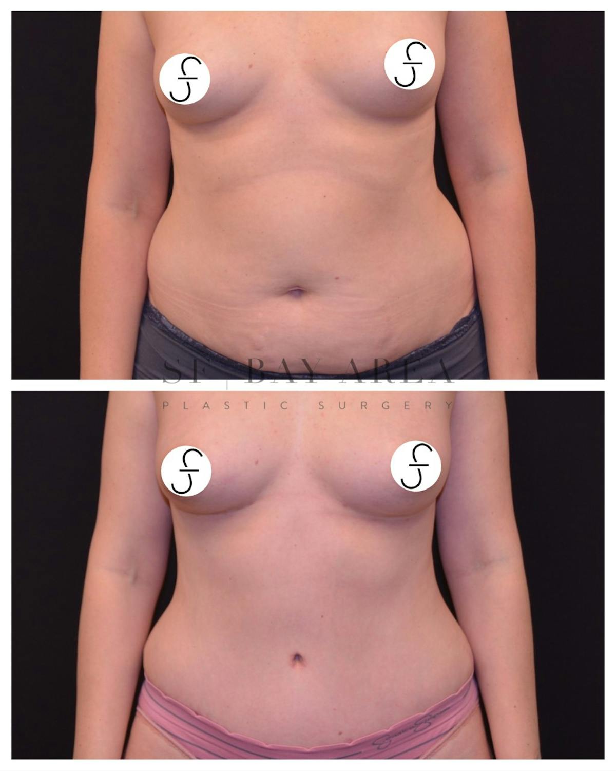 Abdominoplasty (Tummy Tuck) Before & After Gallery - Patient 615736 - Image 1