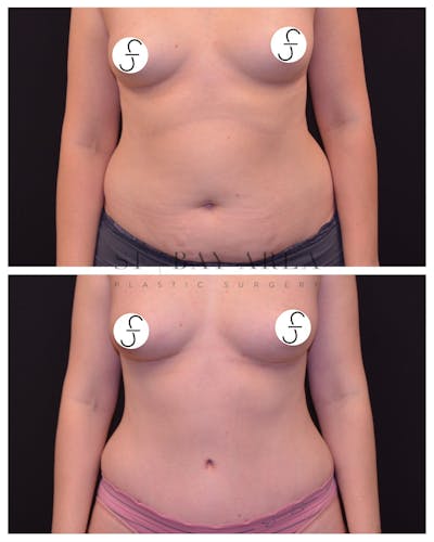 Abdominoplasty (Tummy Tuck) Before & After Gallery - Patient 615736 - Image 1