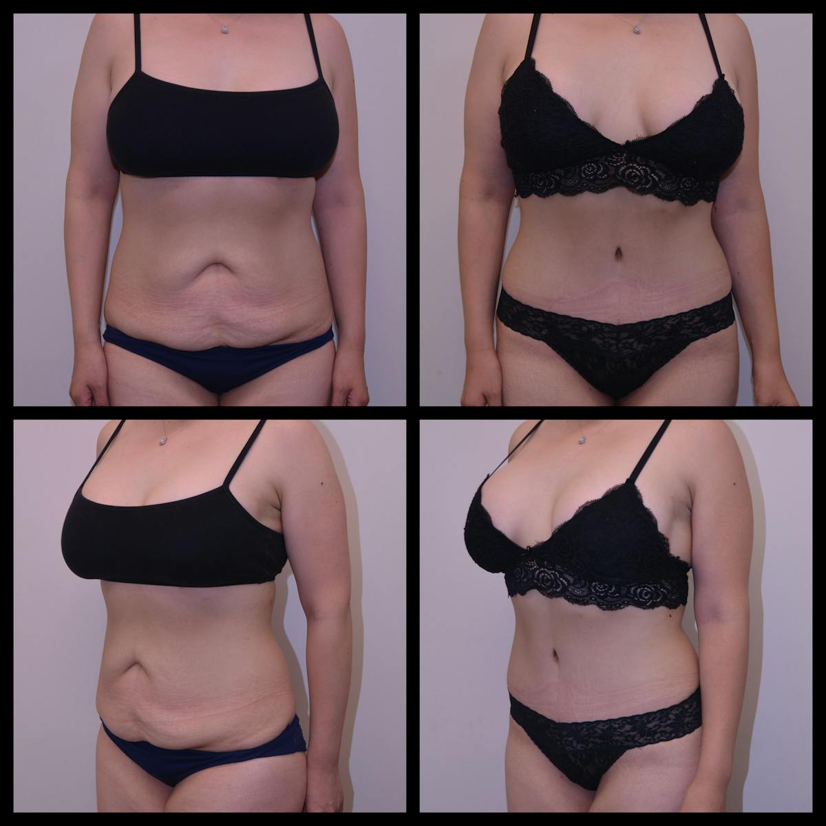 Abdominoplasty (Tummy Tuck) Before & After Gallery - Patient 362599 - Image 1