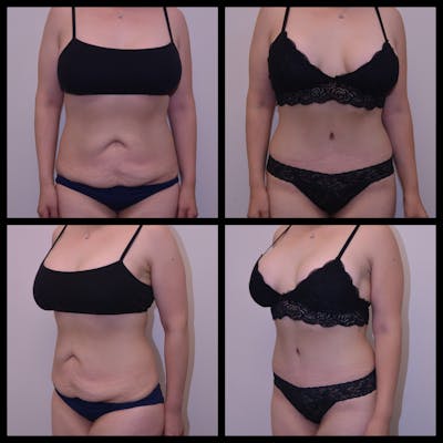 Abdominoplasty (Tummy Tuck) Before & After Gallery - Patient 362599 - Image 1