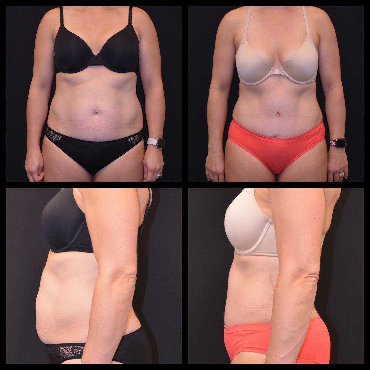 Abdominoplasty (Tummy Tuck) Before & After Gallery - Patient 333263 - Image 1