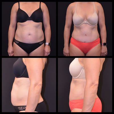 Abdominoplasty (Tummy Tuck) Before & After Gallery - Patient 333263 - Image 1