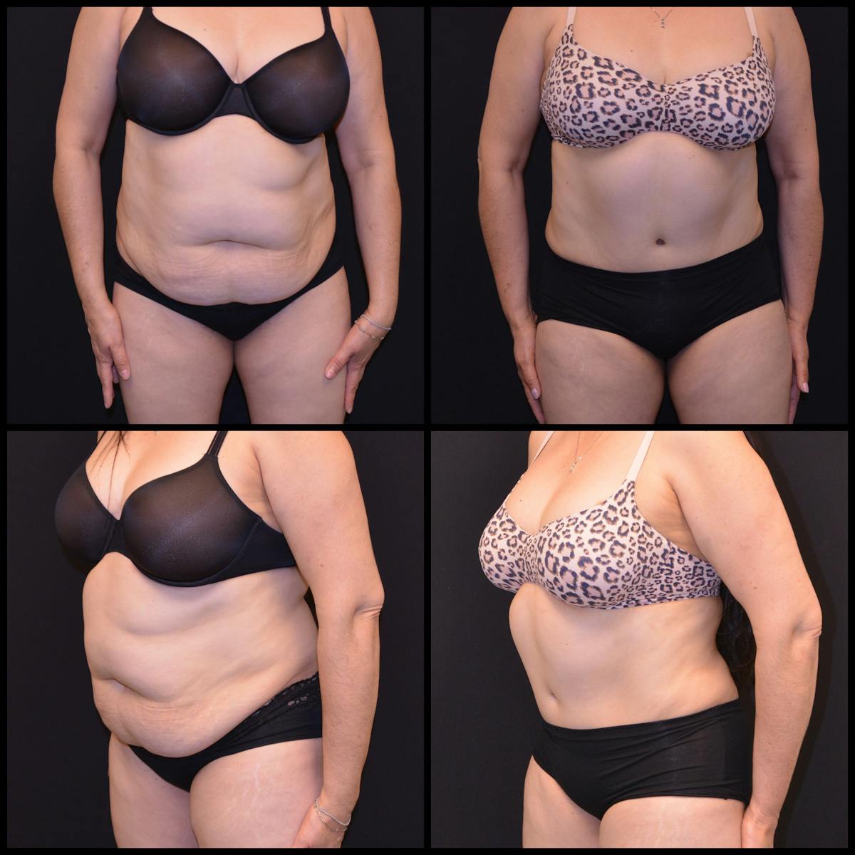 Abdominoplasty (Tummy Tuck) Before & After Gallery - Patient 210156 - Image 1