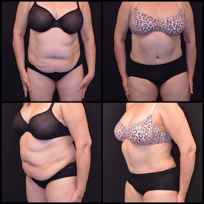 Abdominoplasty (Tummy Tuck) Before & After Gallery - Patient 210156 - Image 1