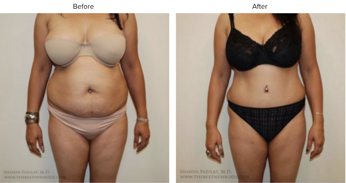 Abdominoplasty (Tummy Tuck) Before & After Gallery - Patient 115141 - Image 1