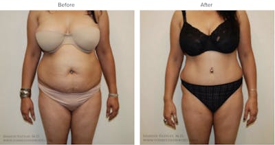Abdominoplasty (Tummy Tuck) Before & After Gallery - Patient 115141 - Image 1