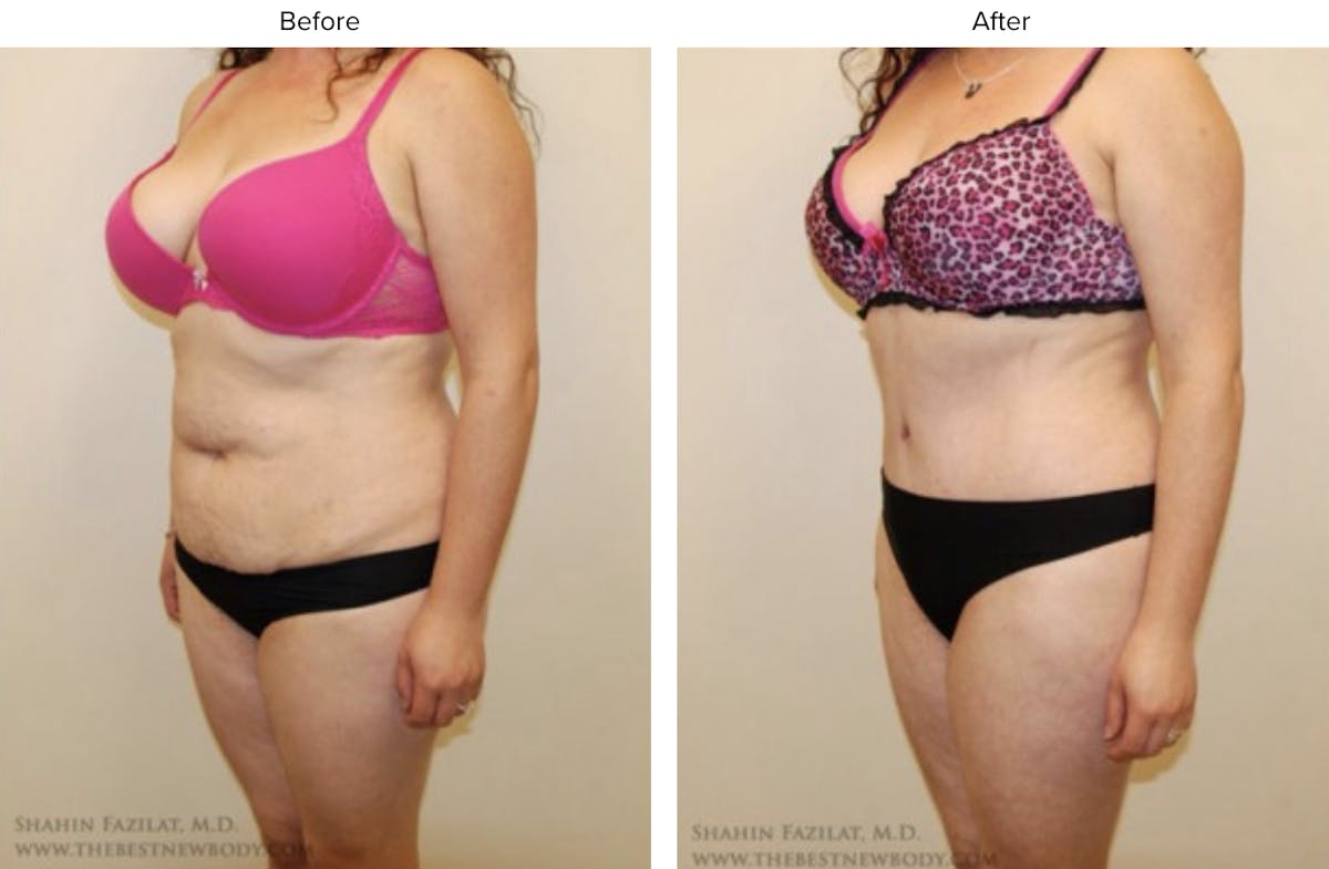 Abdominoplasty (Tummy Tuck) Before & After Gallery - Patient 407190 - Image 2