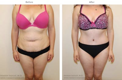 Abdominoplasty (Tummy Tuck) Before & After Gallery - Patient 407190 - Image 1
