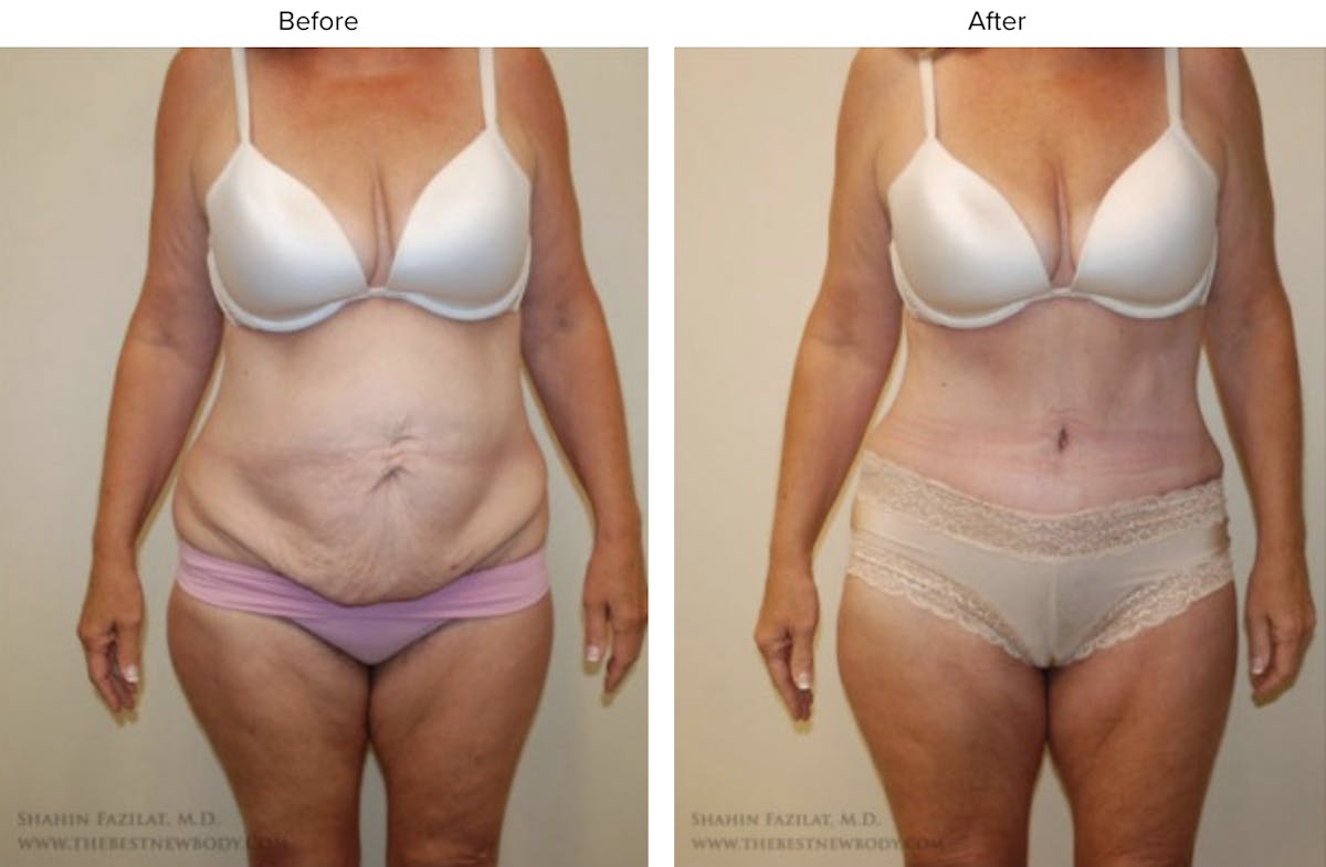 Abdominoplasty (Tummy Tuck) Before & After Gallery - Patient 317473 - Image 1