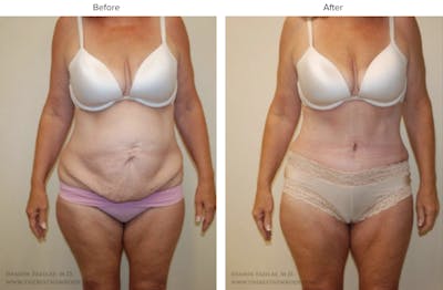 Abdominoplasty (Tummy Tuck) Before & After Gallery - Patient 317473 - Image 1
