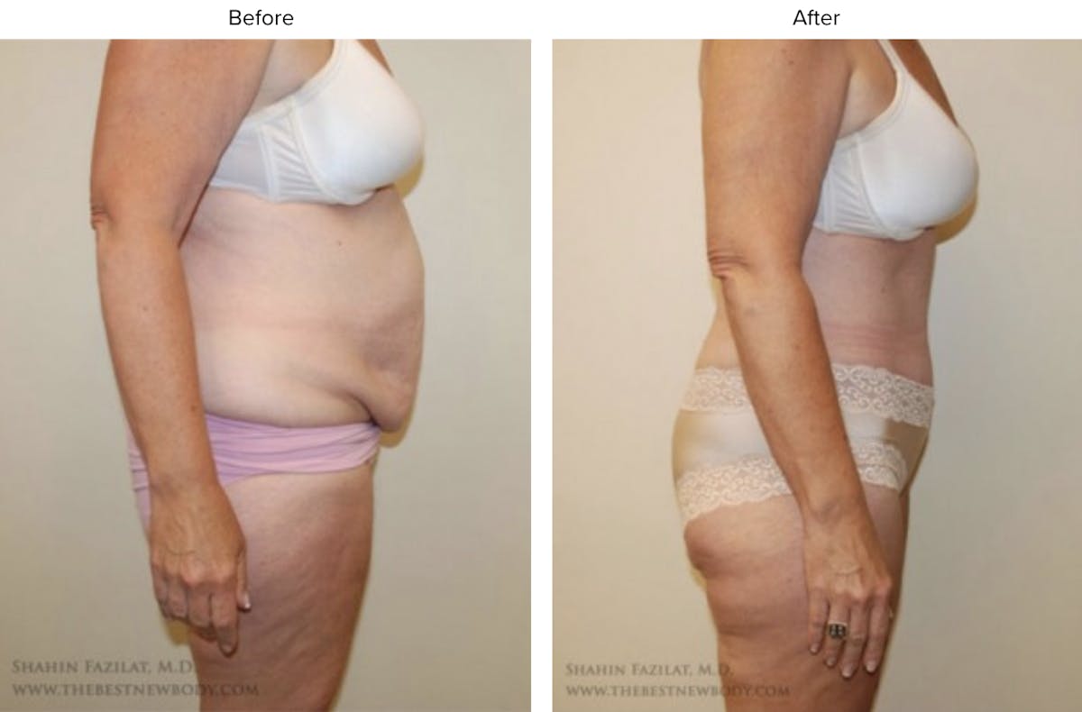 Abdominoplasty (Tummy Tuck) Before & After Gallery - Patient 317473 - Image 2