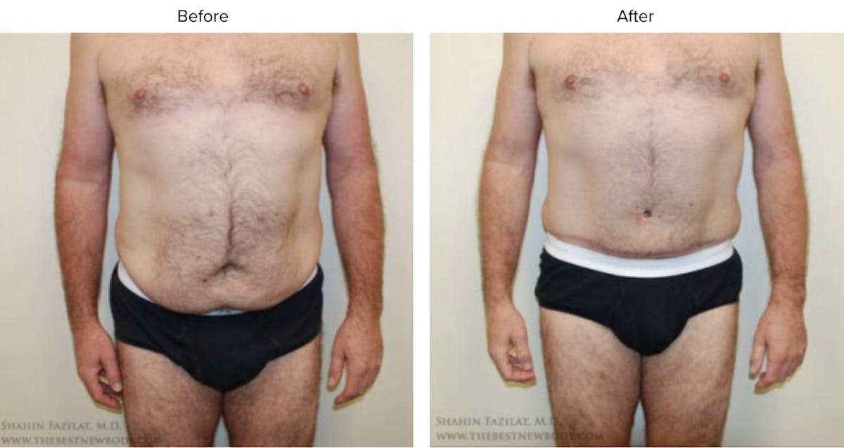 Abdominoplasty (Tummy Tuck) Before & After Gallery - Patient 216257 - Image 1