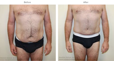 Abdominoplasty (Tummy Tuck) Before & After Gallery - Patient 216257 - Image 1