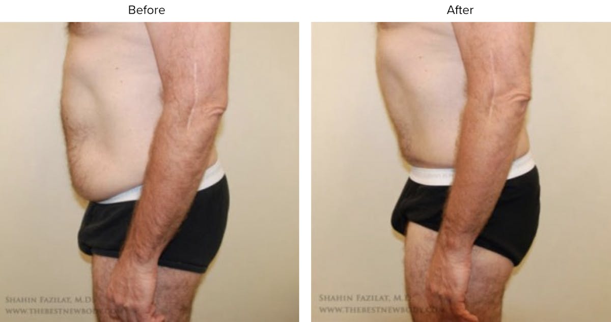 Abdominoplasty (Tummy Tuck) Before & After Gallery - Patient 216257 - Image 2