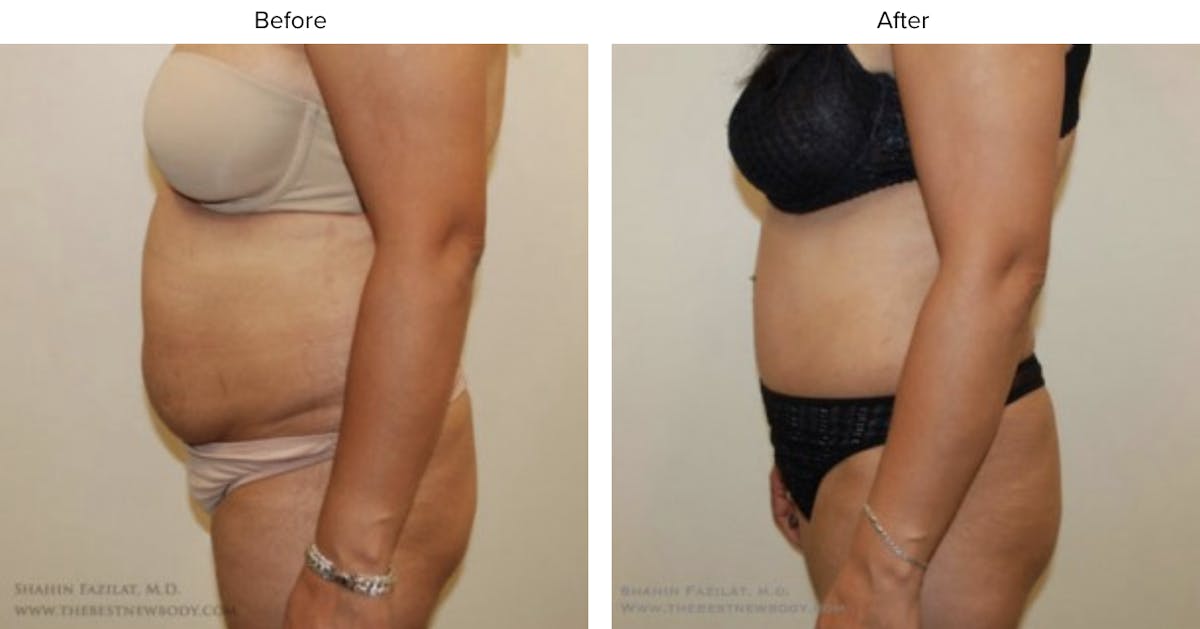 Abdominoplasty (Tummy Tuck) Before & After Gallery - Patient 109405 - Image 1
