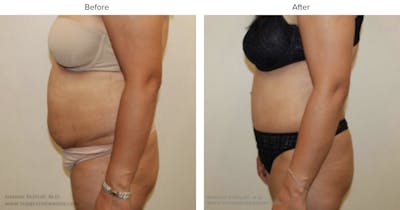 Abdominoplasty (Tummy Tuck) Before & After Gallery - Patient 109405 - Image 1