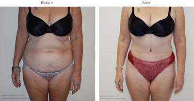 Abdominoplasty (Tummy Tuck) Before & After Gallery - Patient 846816 - Image 1