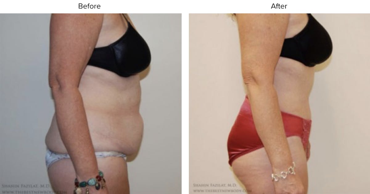 Abdominoplasty (Tummy Tuck) Before & After Gallery - Patient 846816 - Image 2