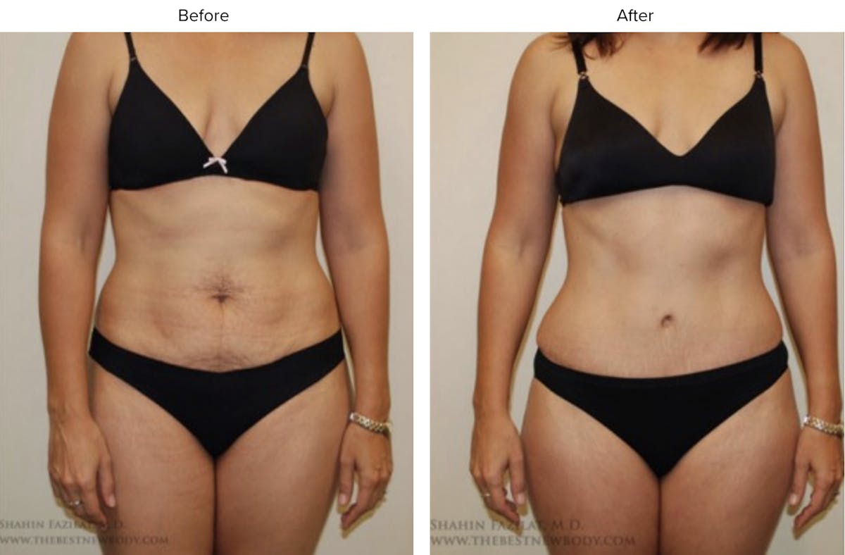 Abdominoplasty (Tummy Tuck) Before & After Gallery - Patient 260154 - Image 1