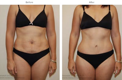 Abdominoplasty (Tummy Tuck) Before & After Gallery - Patient 260154 - Image 1