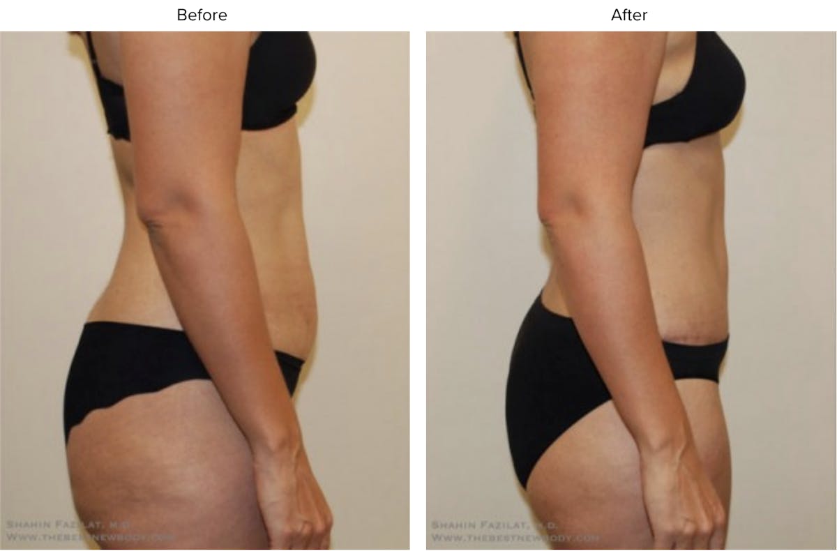 Abdominoplasty (Tummy Tuck) Before & After Gallery - Patient 260154 - Image 2