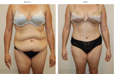 Abdominoplasty (Tummy Tuck) Before & After Gallery - Patient 970450 - Image 1