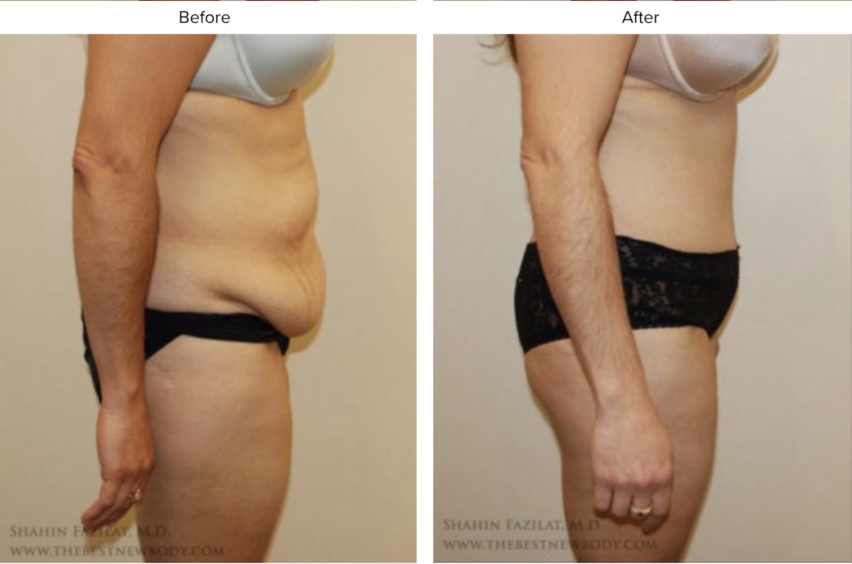 Abdominoplasty (Tummy Tuck) Before & After Gallery - Patient 970450 - Image 2