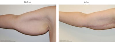Arm Lift Before & After Gallery - Patient 200326 - Image 1