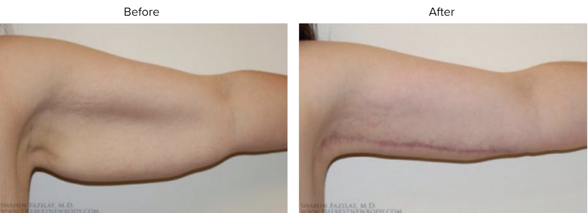 Arm Lift Before & After Gallery - Patient 200326 - Image 2