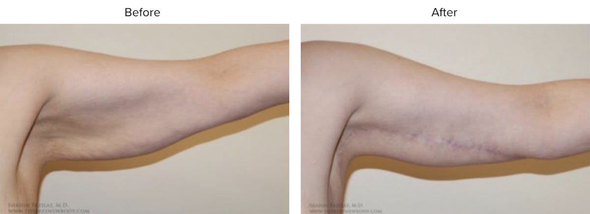 Arm Lift Before & After Gallery - Patient 836425 - Image 2