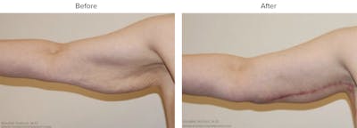 Arm Lift Before & After Gallery - Patient 836425 - Image 1