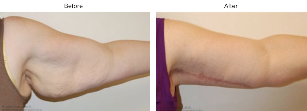 Arm Lift Before & After Gallery - Patient 276348 - Image 2