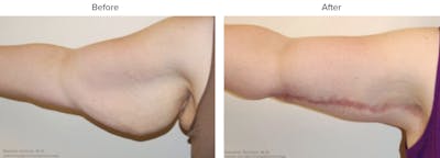 Arm Lift Before & After Gallery - Patient 276348 - Image 1