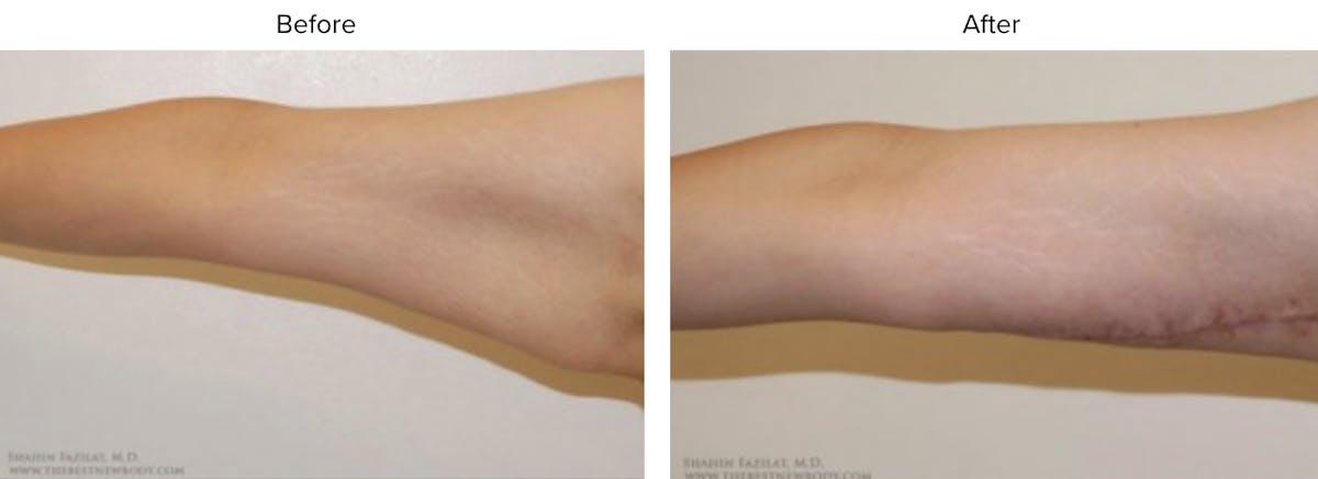 Arm Lift Before & After Gallery - Patient 267585 - Image 1
