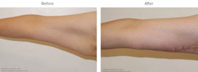 Arm Lift Before & After Gallery - Patient 267585 - Image 1