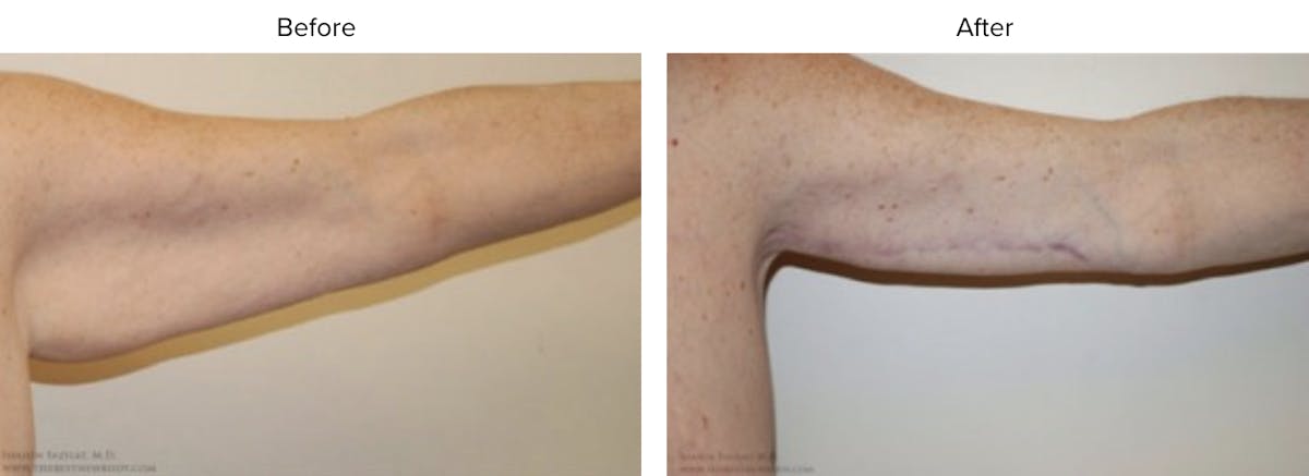 Arm Lift Before & After Gallery - Patient 297542 - Image 2