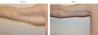Arm Lift Before & After Gallery - Patient 297542 - Image 1
