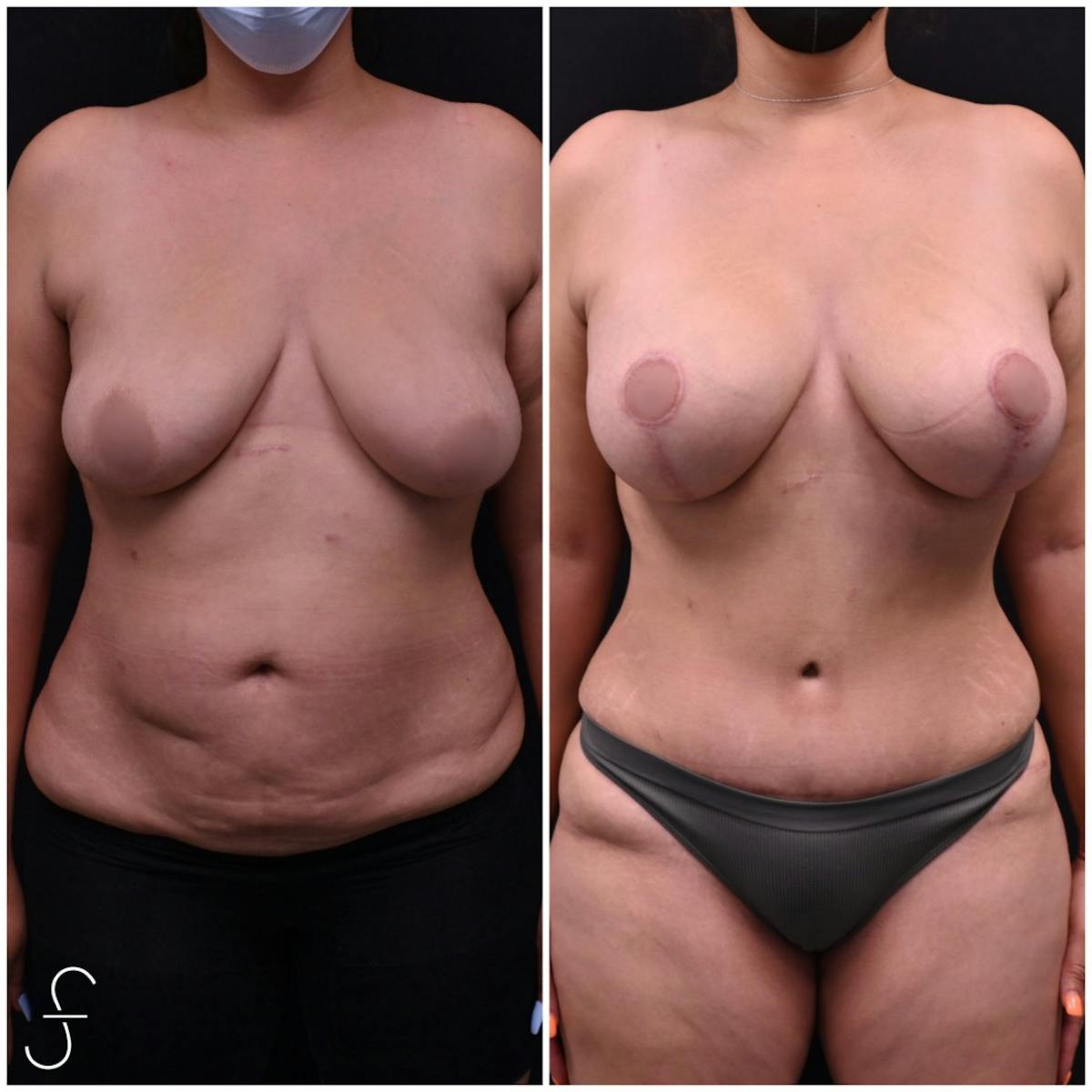 Mommy Makeover Before & After Gallery - Patient 244532 - Image 1